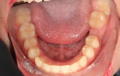Before Metal Braces treatment - Case 84765