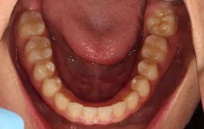 After Metal Braces treatment - Case 84765
