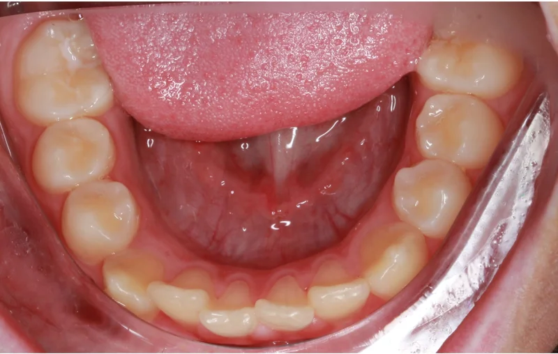 Lower Occlusal - Before Treatment