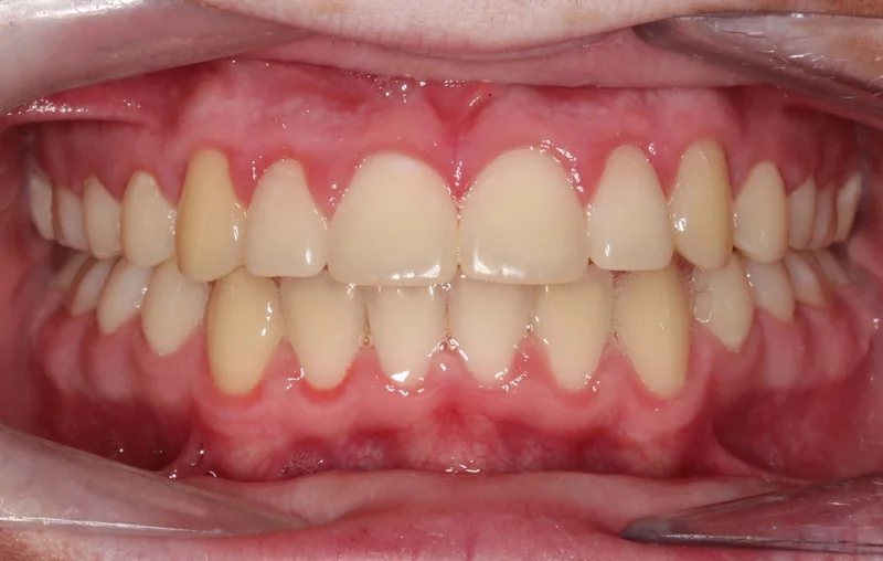 Center Bite - After Treatment