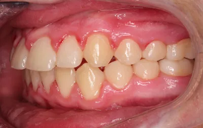After Metal Braces treatment - Case 84790
