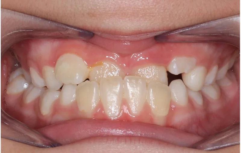 Center Bite - Before Treatment