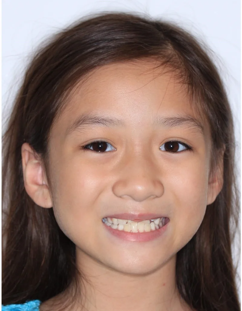Facial Smiling - Before Treatment