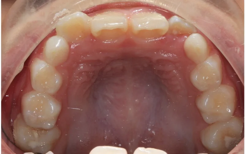 Upper Occlusal - Before Treatment