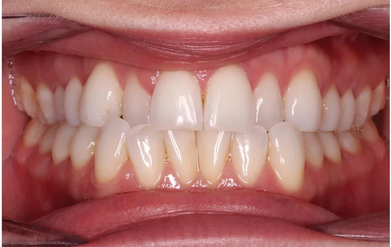 Center Bite - Before Treatment