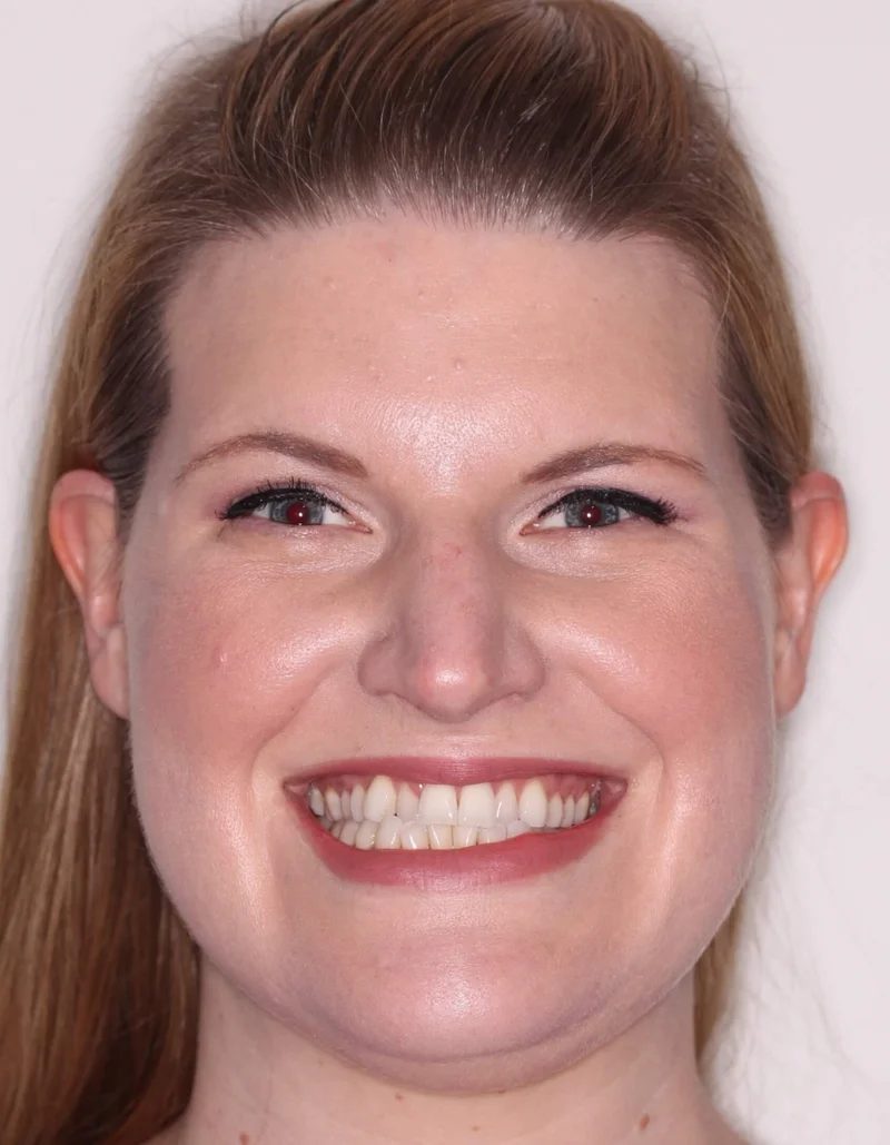 Facial Smiling - Before Treatment