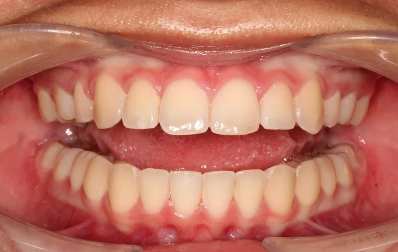Center Open - After Treatment