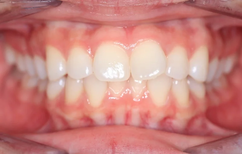 Center Bite - Before Treatment