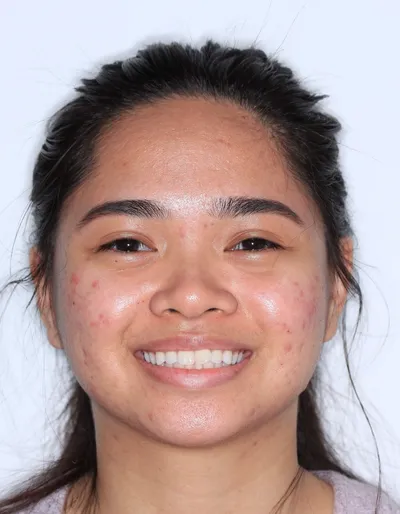 Before Metal Braces treatment - Case 85064
