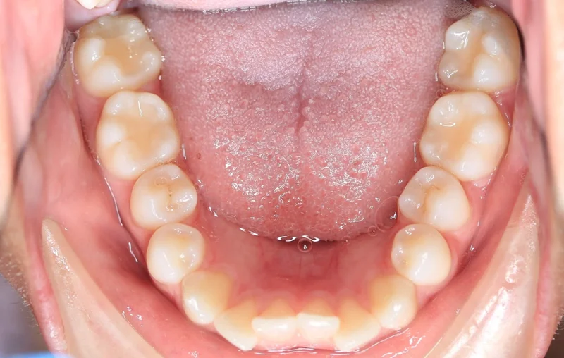 Lower Occlusal - Before Treatment
