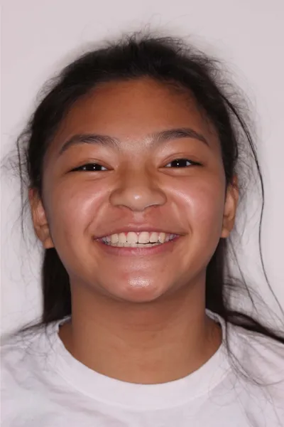 Before Metal Braces treatment - Case 85061