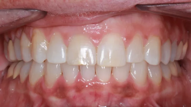 After Removable Clear Aligners treatment - teeth