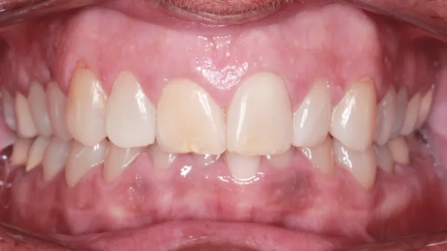Before Removable Clear Aligners treatment - teeth