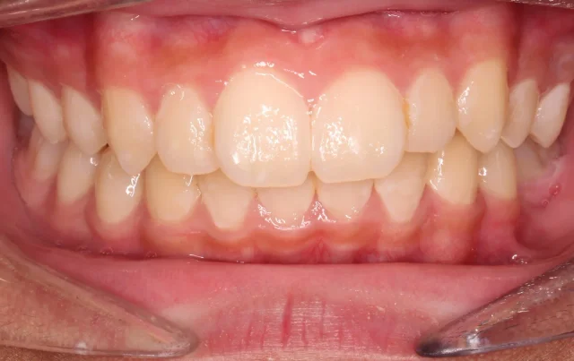 Before Herbst Growth-Guidance Appliance treatment - teeth